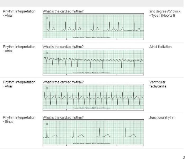 Relias dysrhythmia advanced b test answers