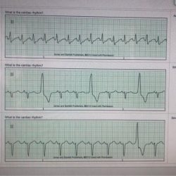 Relias dysrhythmia advanced b test answers