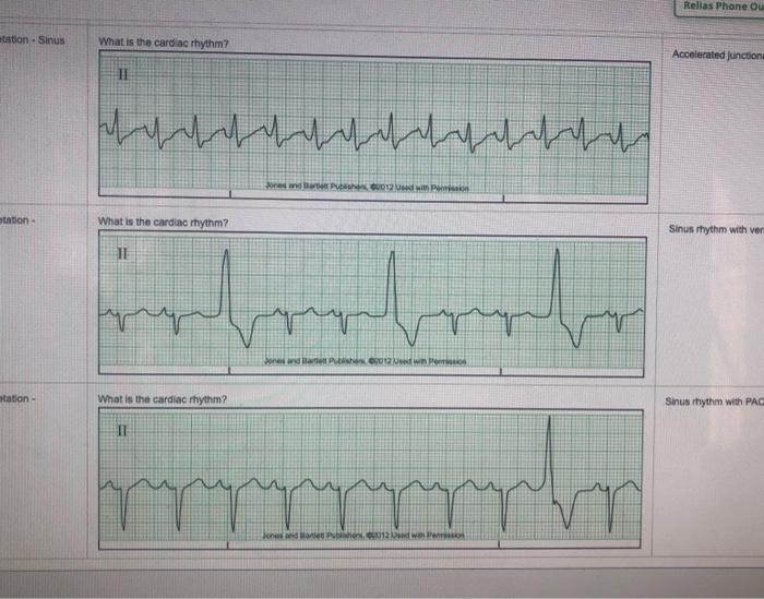 Relias dysrhythmia advanced b test answers